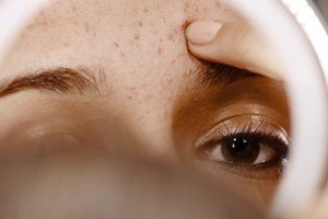 Acne bestaat in verschillende soorten en maten.