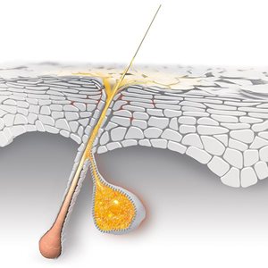 Hormonen stimuleren overproductie van talg waardoor acne kan ontstaan