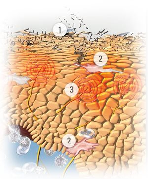 Atopische dermatitis