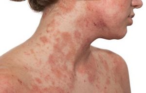 Atopische dermatitis