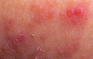 Atopische dermatitis