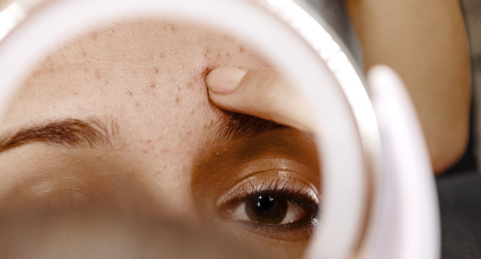 verschillende-typen-acne